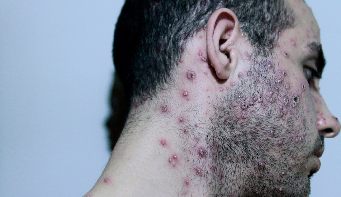 No hay suficientes vacunas contra viruela del mono